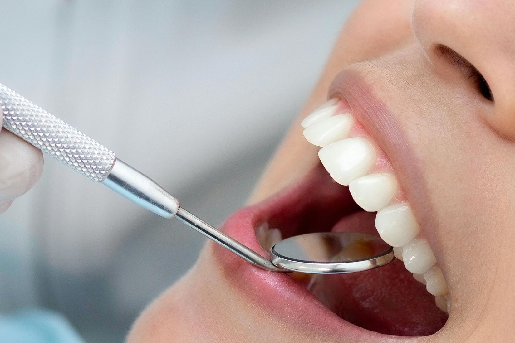 Konya bonding uygulaması, dişlerin ön yüzeyinde veya görünür bölgelerinde yer alan küçük şekil bozukluklarının, sınırlı kırıkların, aralıkların ya da yüzey düzensizliklerinin kompozit esaslı materyallerle düzenlenmesine yönelik estetik diş hekimliği uygulamalarından biridir. Bu yöntemde amaç, diş dokusunu mümkün olduğunca koruyarak dişin formunu, yüzey bütünlüğünü ve estetik uyumunu yeniden değerlendirmektir. Uygulama doğrudan diş üzerinde yapılabildiği için laboratuvar aşaması gerektirmeyen direkt restoratif işlemler arasında yer alır. Konya bonding uygulaması, her estetik sorun için aynı şekilde planlanan standart bir işlem değildir. Uygunluk; dişin mevcut yapısı, mine kalınlığı, kapanış ilişkileri, diş sıkma alışkanlığı, ağız hijyeni ve hastanın beklentileri birlikte değerlendirilerek belirlenir. Bu nedenle bonding uygulaması bazı hastalarda tek dişte sınırlı bir düzeltme amacıyla değerlendirilirken, bazı durumlarda birkaç dişi kapsayan daha geniş estetik planlamaların bir parçası olabilir. Bonding Uygulaması Nedir? Bonding uygulaması, diş yüzeyine adeziv sistemler aracılığıyla kompozit rezin materyal eklenmesi esasına dayanır. Bu materyal dişin doğal katmanlarını taklit edecek şekilde katmanlandırılabilir; renk, opasite ve yüzey formu hastanın doğal diş yapısına uygun biçimde şekillendirilmeye çalışılır. Rezin bazlı kompozitlerin doğrudan diş yüzeyine uygulanabilen, diş renginde estetik restoratif materyaller olduğu ve günümüzde güvenilirliklerinin arttığı belirtilmektedir. Bazı vakalarda diş yüzeyinden çok sınırlı düzeyde madde kaldırılması gerekebilir. Bazı olgularda ise yüzey hazırlığı çok minimal olabilir veya hiç preparasyon gerekmeyebilir. Bu karar, yalnızca estetik görünüm açısından değil, materyalin tutuculuğu, kenar uyumu ve fonksiyonel yüklenmeler dikkate alınarak verilir. Konya Bonding Uygulaması Hangi Durumlarda Değerlendirilebilir? Konya bonding uygulaması şu gibi durumlarda değerlendirilebilir: Ön dişlerde küçük kırık veya çatlakların düzenlenmesi Dişler arasındaki küçük aralıkların kapatılması Diş boyunun veya köşe formunun yeniden şekillendirilmesi Hafif aşınmaların tamamlanması Yüzey konturunda estetik düzensizlik bulunan dişlerin değerlendirilmesi Renk ve form açısından uyumsuz küçük restorasyonların yenilenmesi Bu işlem özellikle sınırlı alanları ilgilendiren ve büyük madde kaybı içermeyen vakalarda daha sık değerlendirilir. Daha yaygın hacim kaybı, ileri derecede renklenme, yoğun bruksizm veya belirgin kapanış problemleri bulunan olgularda farklı restoratif seçenekler ayrıca ele alınabilir. Direkt kompozit restorasyonların dolgu ve veneer benzeri uygulamalarda kullanılabildiği; ancak endikasyonun dişin maruz kaldığı yük ve restorasyonun kapsamına göre belirlenmesi gerektiği ifade edilmektedir. Konya Bonding Uygulaması Nasıl Yapılır? Konya bonding uygulaması genellikle klinik muayene, renk seçimi ve estetik analiz ile başlar. İlk aşamada diş yüzeyi temizlenir ve gerekiyorsa çok sınırlı bir yüzey hazırlığı yapılır. Ardından diş yüzeyi özel adeziv sistemlerle işleme hazırlanır. Kompozit materyal, dişin doğal yapısını taklit edecek şekilde katmanlar halinde uygulanır ve her katman ışıkla sertleştirilir. Rezin kompozit materyallerin çoğu ışıkla polimerize edilerek sertleşir ve adeziv sistemlerle diş yapısına bağlanır. Uygulamanın son aşamasında restorasyonun yüzeyi şekillendirilir, polisaj yapılır ve kapanış kontrol edilir. Bu aşama yalnızca estetik görünüm için değil, restorasyonun fonksiyonel dengesi açısından da önemlidir. Çünkü ön bölgede yapılan küçük bir ekleme bile kapanışta erken temas oluşturursa, uzun dönemli dayanıklılık etkilenebilir. Konya Bonding Uygulamasının Özellikleri Konya bonding uygulaması, direkt bir restoratif yöntem olması nedeniyle bazı pratik avantajlar sunabilir. Laboratuvar süreci gerektirmemesi nedeniyle bazı vakalarda uygulama daha kısa klinik planlama ile tamamlanabilir. Ayrıca materyalin doğrudan diş üzerine uygulanabilmesi, sınırlı değişiklik yapılması gereken durumlarda koruyucu bir yaklaşım sağlayabilir. ADA kaynaklarında da kompozit materyallerin diş renginde olması ve adeziv bağlanma özelliği, bu materyallerin temel avantajları arasında sayılmaktadır. Bununla birlikte bonding uygulaması ile seramik esaslı indirekt restorasyonlar aynı materyal özelliklerine sahip değildir. Kompozit materyaller zaman içinde dış etkenlere bağlı olarak yüzey parlaklığında değişiklik, pigment tutulumuna bağlı renk farklılığı veya kenar uyumunda değişiklik gösterebilir. Kompozit materyaller için potansiyel dezavantajlar arasında leke tutma ve renk değişikliği yer almaktadır. Bu nedenle Konya bonding uygulaması planlanırken, yalnızca ilk görünüm değil, ağız içindeki kullanım koşulları ve bakım alışkanlıkları da göz önünde bulundurulur. Bonding Uygulaması ile Seramik Lamina Arasındaki Genel Fark Bonding uygulaması ile seramik lamina veya diğer indirekt restorasyonlar aynı grup işlemler değildir. Bonding’de kompozit materyal doğrudan diş üzerine uygulanır. Seramik restorasyonlarda ise genellikle laboratuvar üretimi gerekir ve materyalin optik, mekanik ve yüzey özellikleri farklıdır. İndirekt restorasyonların laboratuvar aşaması gerektirdiği ve materyal çeşitliliğinin klinik gereksinimlere göre değiştiği belirtilmektedir. Bu nedenle hangi yöntemin uygun olduğu yalnızca estetik beklentiye göre değil; dişin yapısı, kayıp miktarı, kapanış ilişkileri, diş sıkma alışkanlığı ve uzun dönem bakım olanakları dikkate alınarak belirlenir. TDB’ye uygun yaklaşımda bir yöntemin diğerine göre kesin biçimde üstün olduğu ifade edilmemeli; her uygulama uygun vaka içinde ayrı değerlendirilmelidir. Konya Bonding Uygulaması Ne Kadar Sürede Tamamlanabilir? Konya bonding uygulaması bazı olgularda tek seansta planlanabilen işlemler arasında yer alabilir. Ancak bu durum her vaka için aynı değildir. Uygulanacak diş sayısı, estetik analiz gereksinimi, renk uyumu, kapanış düzenlemeleri ve mevcut restorasyonların durumu seans planını etkileyebilir. Tek dişte küçük bir düzeltme ile birkaç dişi kapsayan estetik düzenleme aynı sürede tamamlanmayabilir. Bonding Uygulamasında Renk Değişimi Olur mu? Kompozit materyaller zaman içinde çay, kahve, sigara ve benzeri dış pigmentlere bağlı olarak yüzeysel renk değişikliği gösterebilir. Bu durum her hastada aynı hızda ortaya çıkmaz. Ağız hijyeni, beslenme alışkanlıkları, düzenli polisaj kontrolleri ve sigara kullanımı gibi faktörler bu süreci etkileyebilir. ADA’nın doğrudan restoratif materyallerle ilgili özetinde de kompozitlerin potansiyel dezavantajları arasında leke tutma ve renk değişikliği sayılmaktadır. Bu nedenle Konya bonding uygulaması sonrasında düzenli bakım ve belirli aralıklarla klinik kontrol önem taşır. Kimler İçin Dikkatli Değerlendirilir? Her estetik uygulama her hasta için uygun olmayabilir. Konya bonding uygulaması şu durumlarda daha dikkatli değerlendirilir: Yoğun diş sıkma ve gıcırdatma alışkanlığı Belirgin kapanış bozuklukları Yaygın ve derin renklenmeler Geniş alanı kapsayan madde kayıpları Diş eti sağlığının aktif olarak bozulduğu tablolar Ağız hijyeninin yetersiz olduğu durumlar Bu gibi durumlarda önce periodontal veya fonksiyonel problemlerin ele alınması gerekebilir. Uygulama kararı bireysel muayene ve klinik analiz sonrasında verilir. Konya Bonding Uygulaması Sonrası Bakım Konya bonding uygulaması sonrası bakım, restorasyonun yüzey kalitesi ve ağız içi takibi açısından önemlidir. Genellikle şu başlıklar öne çıkar: Düzenli diş fırçalama Ara yüz temizliğinin sürdürülmesi Sert cisimleri dişle kırma alışkanlığından kaçınılması Çay, kahve ve sigara gibi dış etkenlerin yüzey üzerindeki etkisinin göz önünde bulundurulması Kontrol randevularının sürdürülmesi Uzun dönem kullanım süresi; materyalin kendisi kadar hastanın alışkanlıkları, kapanışı, ağız hijyeni ve düzenli kontrollerine bağlı olarak değişebilir. Bu nedenle bonding uygulamasının kalıcılığı konusunda kesin süre vermek uygun değildir. Konya Bonding Uygulaması Hakkında Genel Değerlendirme Konya bonding uygulaması, özellikle ön bölgede sınırlı estetik ve yapısal düzenlemelerin değerlendirilmesinde kullanılan direkt restoratif yöntemlerden biridir. Diş dokusuna mümkün olduğunca koruyucu yaklaşım sağlanabilmesi, laboratuvar gerektirmeden uygulanabilmesi ve diş renginde materyallerle planlanabilmesi nedeniyle uygun vakalarda değerlendirilebilir. Bununla birlikte bonding, her estetik problem için tek seçenek olarak görülmemelidir. Konya bonding uygulaması planlanırken dişin yapısı, yüzey alanı, kapanış ilişkileri, estetik beklenti, ağız hijyeni ve alışkanlıklar birlikte değerlendirilir. Amaç; biyolojik sınırlar içinde estetik ve fonksiyonel uyumu destekleyen restoratif bir yaklaşım planlamaktır.