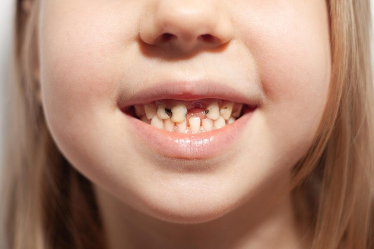 Biberon çürüğünün oluşumunu ve erken korunma yöntemlerini anlatan bilgilendirici çocuk diş sağlığı görseli.