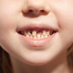 Biberon çürüğünün oluşumunu ve erken korunma yöntemlerini anlatan bilgilendirici çocuk diş sağlığı görseli.