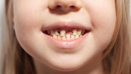 Biberon çürüğünün oluşumunu ve erken korunma yöntemlerini anlatan bilgilendirici çocuk diş sağlığı görseli.