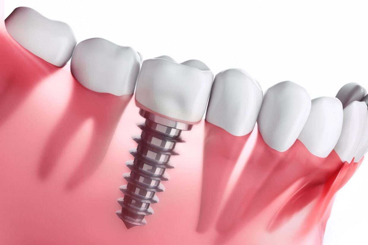 Diş implantı tedavi süreci ve sonrası ağız bakımını gösteren bilgilendirici görsel.