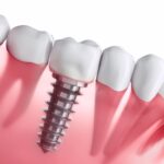 Diş implantı tedavi süreci ve sonrası ağız bakımını gösteren bilgilendirici görsel.