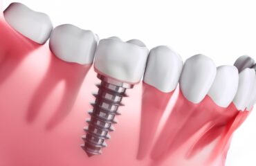 Diş implantı tedavi süreci ve sonrası ağız bakımını gösteren bilgilendirici görsel.