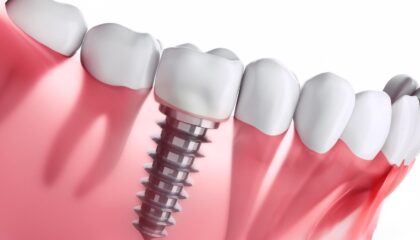 Diş implantı tedavi süreci ve sonrası ağız bakımını gösteren bilgilendirici görsel.