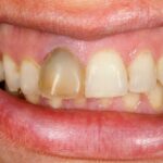 Travma sonrası diş yaralanmalarında ilk adımları anlatan bilgilendirici acil durum görseli.