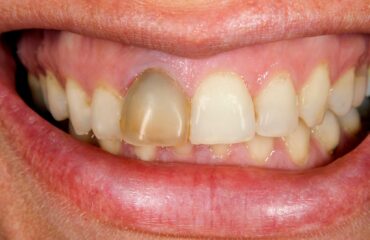 Travma sonrası diş yaralanmalarında ilk adımları anlatan bilgilendirici acil durum görseli.