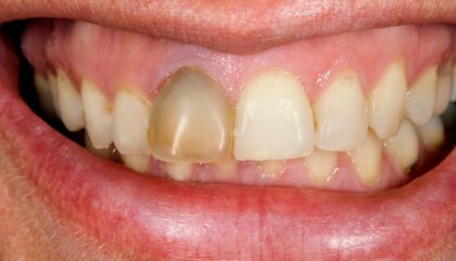 Travma sonrası diş yaralanmalarında ilk adımları anlatan bilgilendirici acil durum görseli.