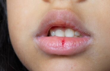 agiz-kurulugu-xerostomi-nedir Ağız kuruluğunun nedenlerini, belirtilerini ve ağız sağlığına etkilerini anlatan bilgilendirici görsel.