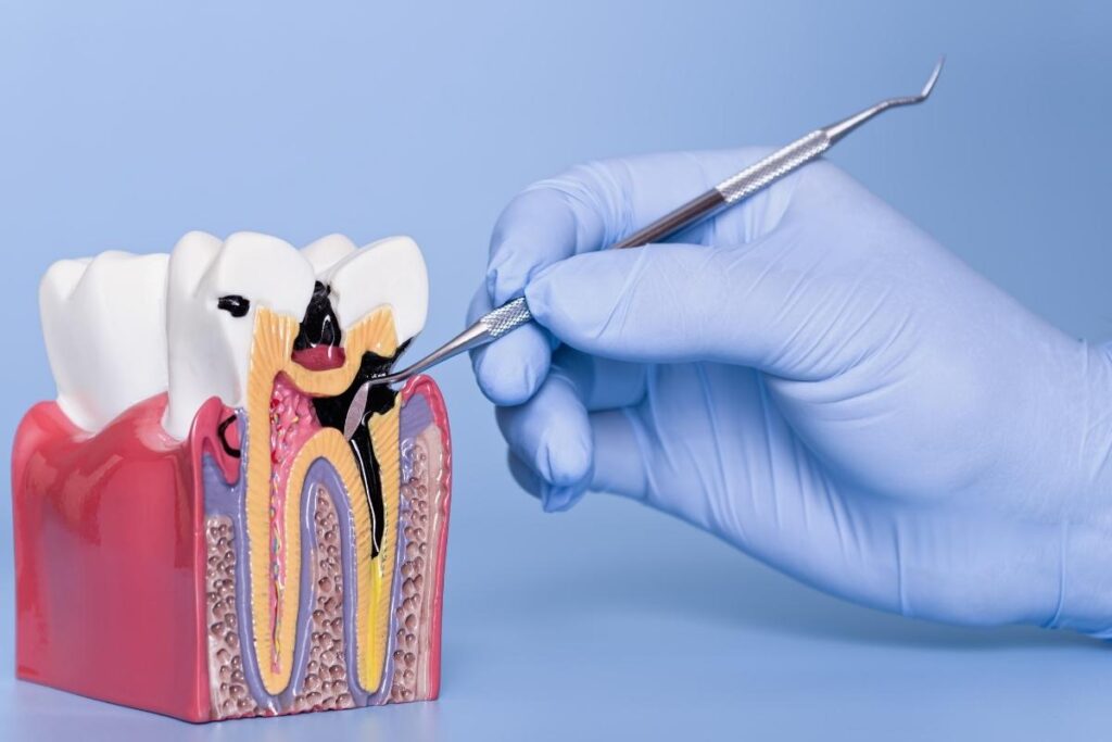 Diş çürüğünün başlangıçtan ileri evreye kadar gelişim sürecini gösteren bilgilendirici görsel.