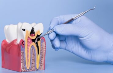 Diş çürüğünün başlangıçtan ileri evreye kadar gelişim sürecini gösteren bilgilendirici görsel.