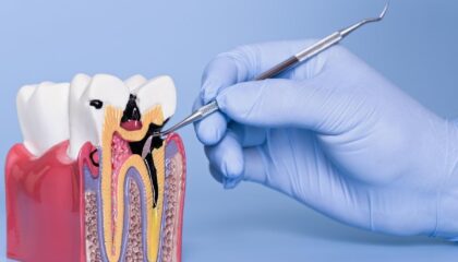 Diş çürüğünün başlangıçtan ileri evreye kadar gelişim sürecini gösteren bilgilendirici görsel.