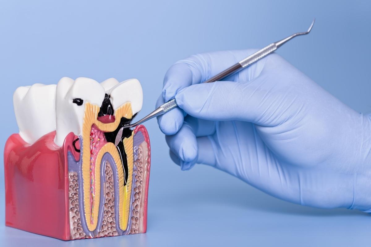 Diş çürüğünün başlangıçtan ileri evreye kadar gelişim sürecini gösteren bilgilendirici görsel.