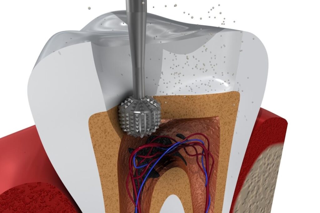 Kanal tedavisinin aşamalarını ve iyileşme sürecini gösteren bilgilendirici görsel.