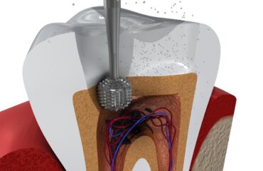 Kanal tedavisinin aşamalarını ve iyileşme sürecini gösteren bilgilendirici görsel.