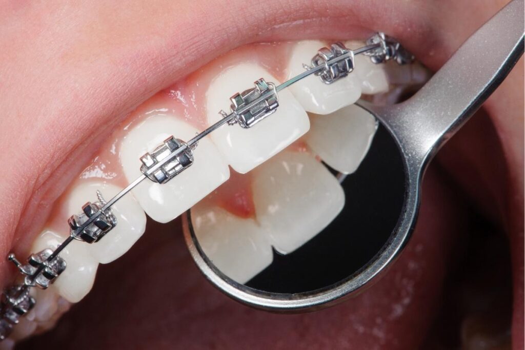 Ortodontik tedavi öncesi ve sonrası dikkat edilmesi gerekenleri gösteren bilgilendirici görsel.