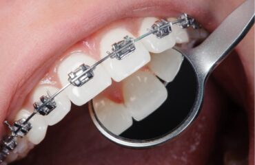 Ortodontik tedavi öncesi ve sonrası dikkat edilmesi gerekenleri gösteren bilgilendirici görsel.