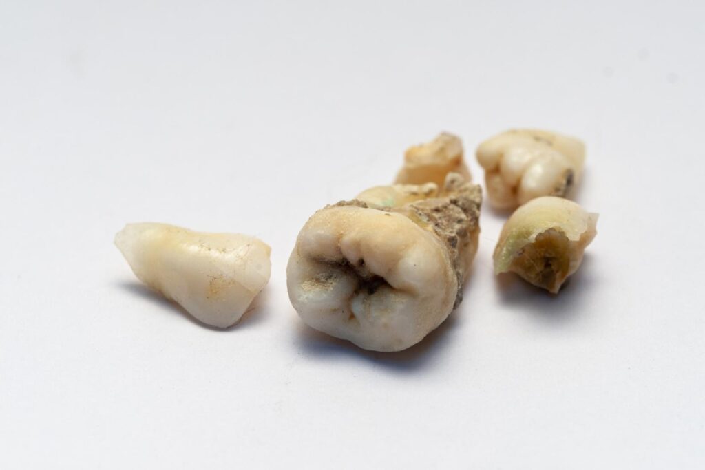 Çocuklarda diş çürüğünün nedenlerini ve ağız bakımında ailelerin dikkat etmesi gerekenleri anlatan bilgilendirici görsel.