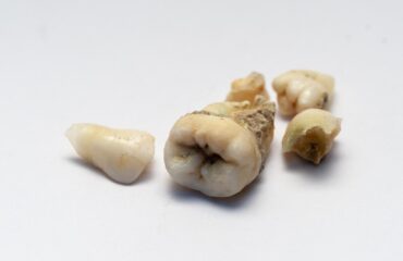 Çocuklarda diş çürüğünün nedenlerini ve ağız bakımında ailelerin dikkat etmesi gerekenleri anlatan bilgilendirici görsel.