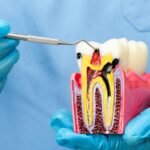 Kanal tedavisi gerektiren durumları ve dişin iç yapısındaki iltihabi süreci gösteren bilgilendirici görsel.