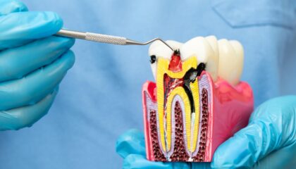 Kanal tedavisi gerektiren durumları ve dişin iç yapısındaki iltihabi süreci gösteren bilgilendirici görsel.