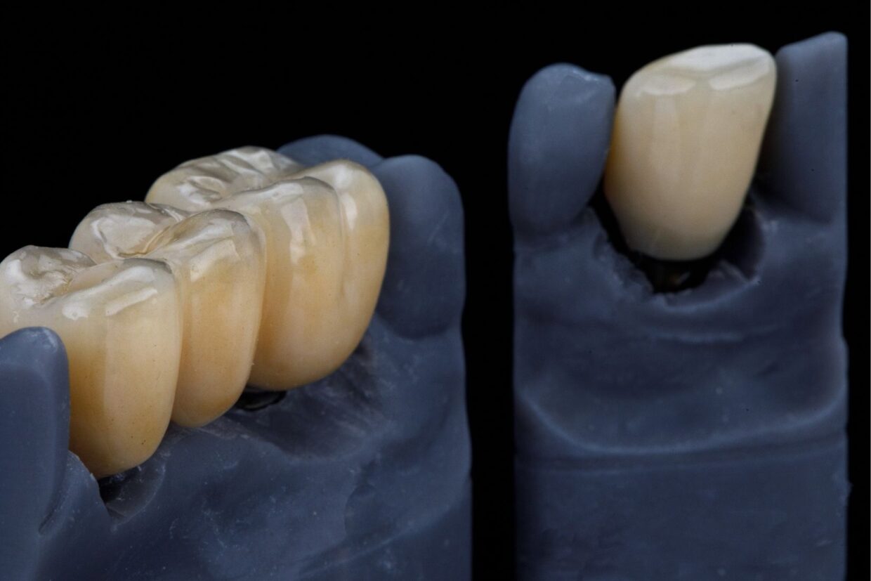 Zirkonyum ve porselen kaplamaların estetik görünüm ve altyapı farklarını karşılaştıran bilgilendirici görsel.