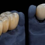 Zirkonyum ve porselen kaplamaların estetik görünüm ve altyapı farklarını karşılaştıran bilgilendirici görsel.