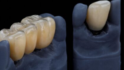 Zirkonyum ve porselen kaplamaların estetik görünüm ve altyapı farklarını karşılaştıran bilgilendirici görsel.