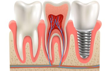 Diş implantı yerleştirme sürecini ve kemik-implant uyumunu gösteren ağız içi klinik görsel.