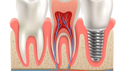 Diş implantı yerleştirme sürecini ve kemik-implant uyumunu gösteren ağız içi klinik görsel.