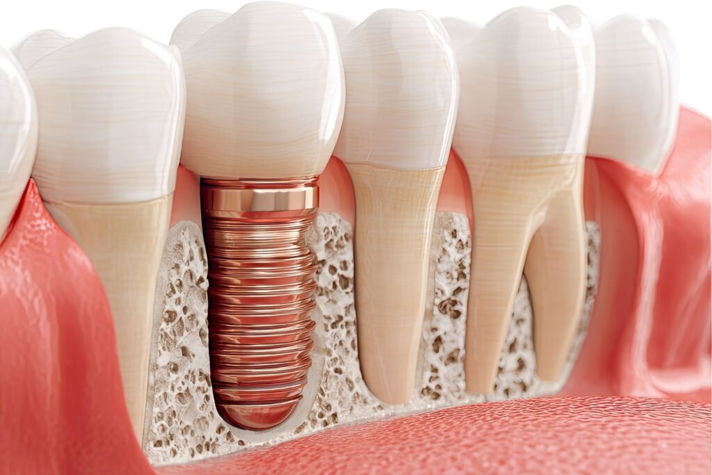 Dental implantın çene kemiğine yerleşimini ve implant tedavisi öncesi değerlendirme sürecini gösteren bilgilendirici görsel.