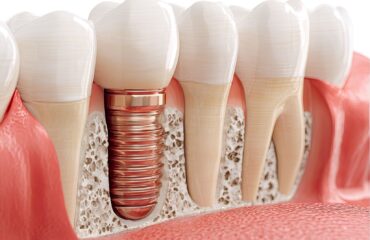 Dental implantın çene kemiğine yerleşimini ve implant tedavisi öncesi değerlendirme sürecini gösteren bilgilendirici görsel.