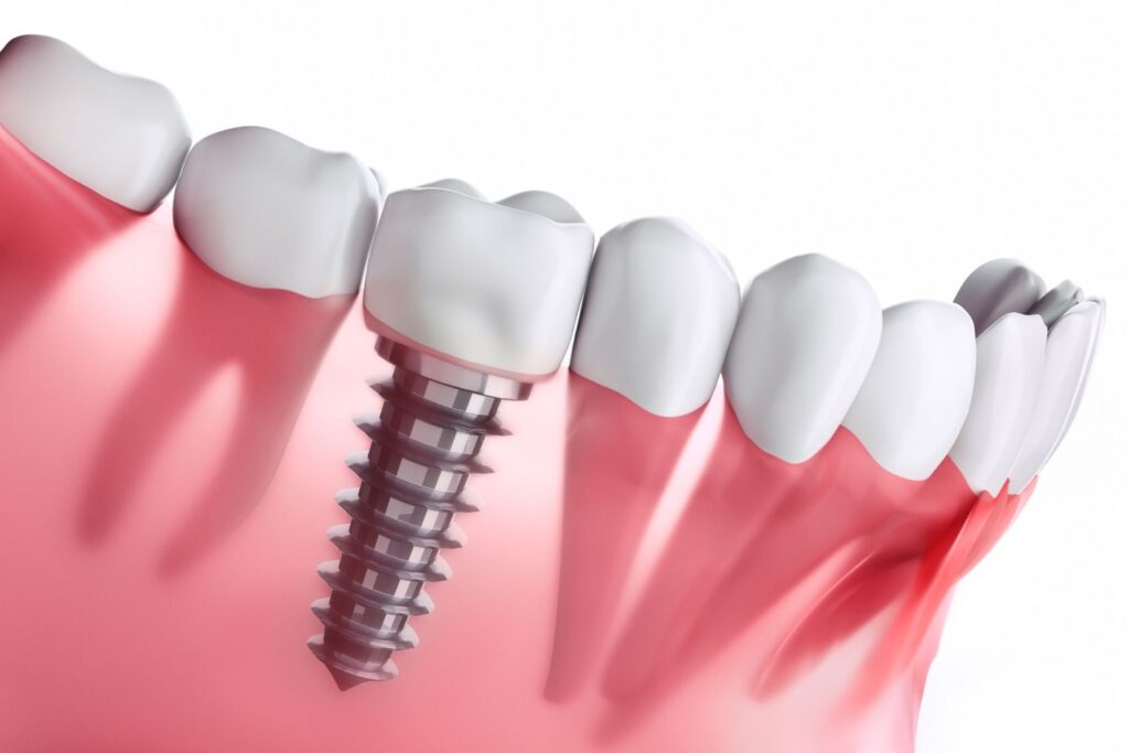 Dental implantın çene kemiğine yerleşimini ve implant tedavisi planlama sürecini gösteren bilgilendirici görsel.