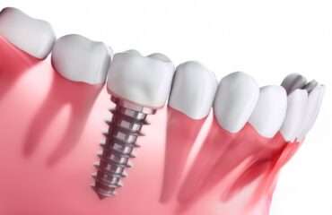 Dental implantın çene kemiğine yerleşimini ve implant tedavisi planlama sürecini gösteren bilgilendirici görsel.