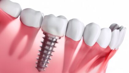 Dental implantın çene kemiğine yerleşimini ve implant tedavisi planlama sürecini gösteren bilgilendirici görsel.