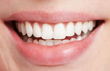 Kompozit bonding ve lamina veneer uygulamalarının estetik planlama sürecini gösteren diş hekimliği görseli.