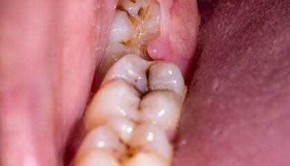 20 yaş dişinin konumunu ve ağrı nedenlerinin değerlendirildiği diş hekimliği muayenesi.