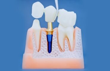 konya-implant-sonrasi-iyilesme-sureci İmplant uygulaması sonrası kontrol muayenesini ve iyileşme sürecini gösteren diş hekimliği görseli.
