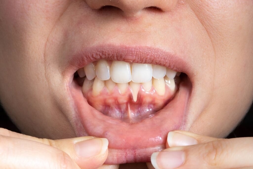 Periodontal hastalık değerlendirmesi sırasında diş eti ve destek dokuların incelendiği diş hekimliği muayenesi.