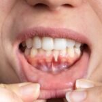 Periodontal hastalık değerlendirmesi sırasında diş eti ve destek dokuların incelendiği diş hekimliği muayenesi.