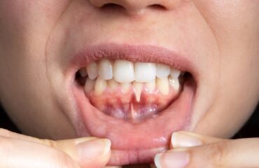 Periodontal hastalık değerlendirmesi sırasında diş eti ve destek dokuların incelendiği diş hekimliği muayenesi.