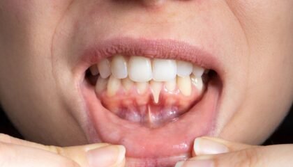 Periodontal hastalık değerlendirmesi sırasında diş eti ve destek dokuların incelendiği diş hekimliği muayenesi.