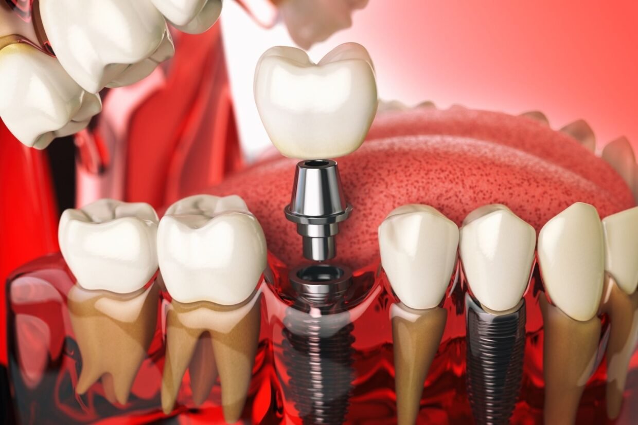 İmplant çevresindeki diş eti dokularının değerlendirildiği implant kontrol muayenesi.