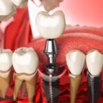 İmplant çevresindeki diş eti dokularının değerlendirildiği implant kontrol muayenesi.