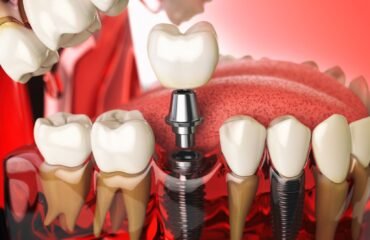 İmplant çevresindeki diş eti dokularının değerlendirildiği implant kontrol muayenesi.