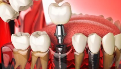 İmplant çevresindeki diş eti dokularının değerlendirildiği implant kontrol muayenesi.