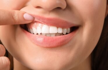 Konya’da diş eti kanaması ve periodontal dokuların değerlendirildiği ayrıntılı diş hekimi muayenesi.