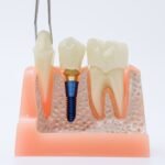 İmplant çevresi dokuların periodontal açıdan değerlendirildiği diş hekimliği muayenesi.