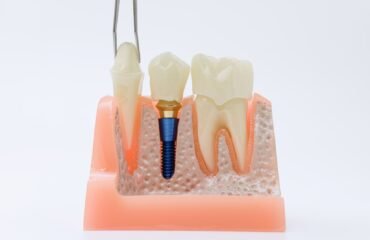 İmplant çevresi dokuların periodontal açıdan değerlendirildiği diş hekimliği muayenesi.
