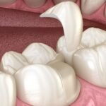 İnley ve onley restorasyon planlamasında diş dokusu ve çiğneme yüzeyinin değerlendirildiği klinik muayene.