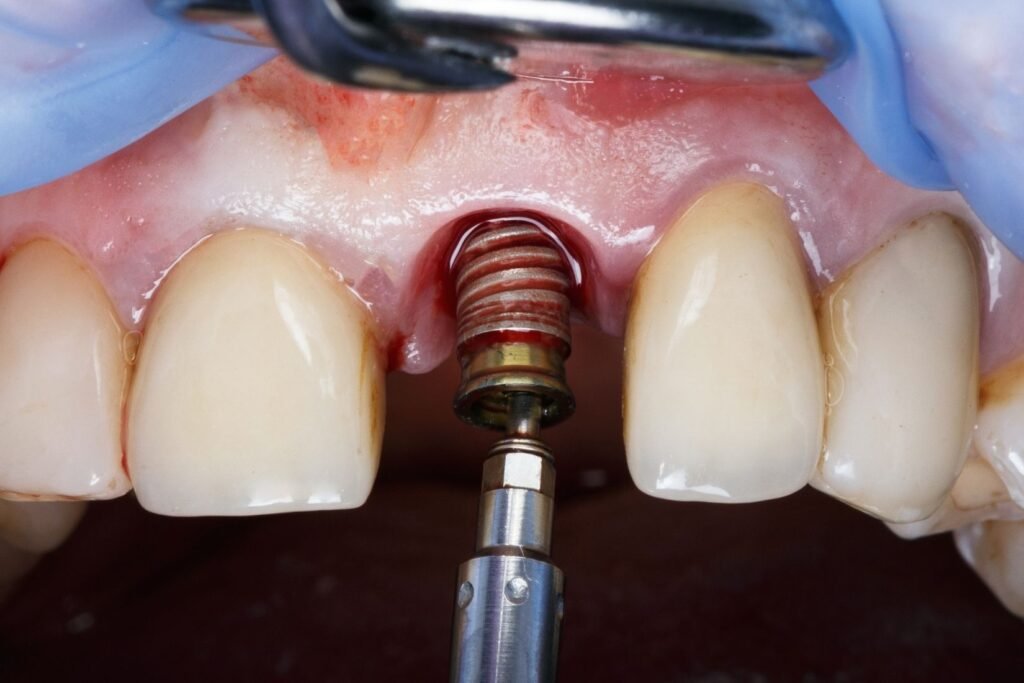 İmplant sonrası ağrı ve hassasiyetin diş eti, implant çevresi ve kapanış açısından değerlendirildiği klinik muayene.